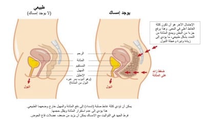 Normal versus Constipation - Arabic