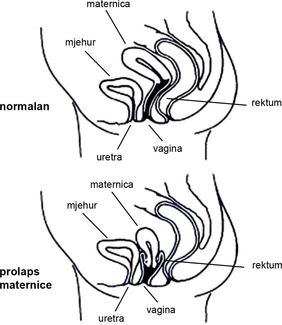 Prolapse