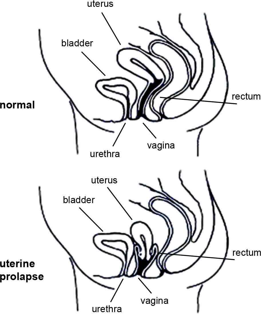 Prolapse