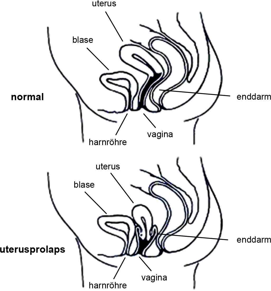 Prolapse