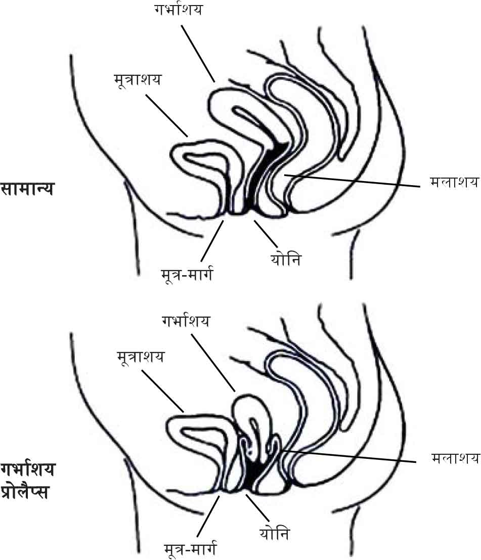 Prolapse