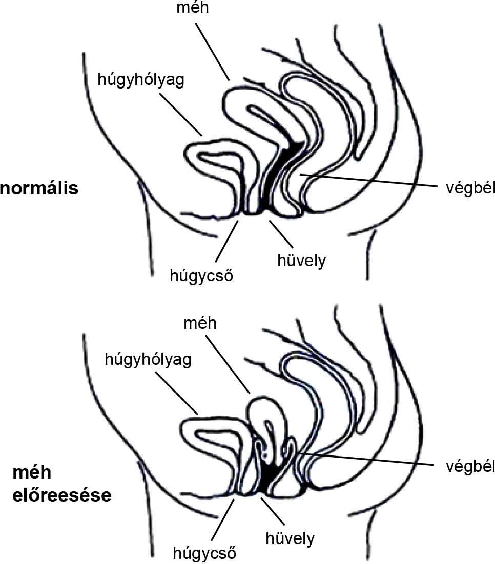 Prolapse