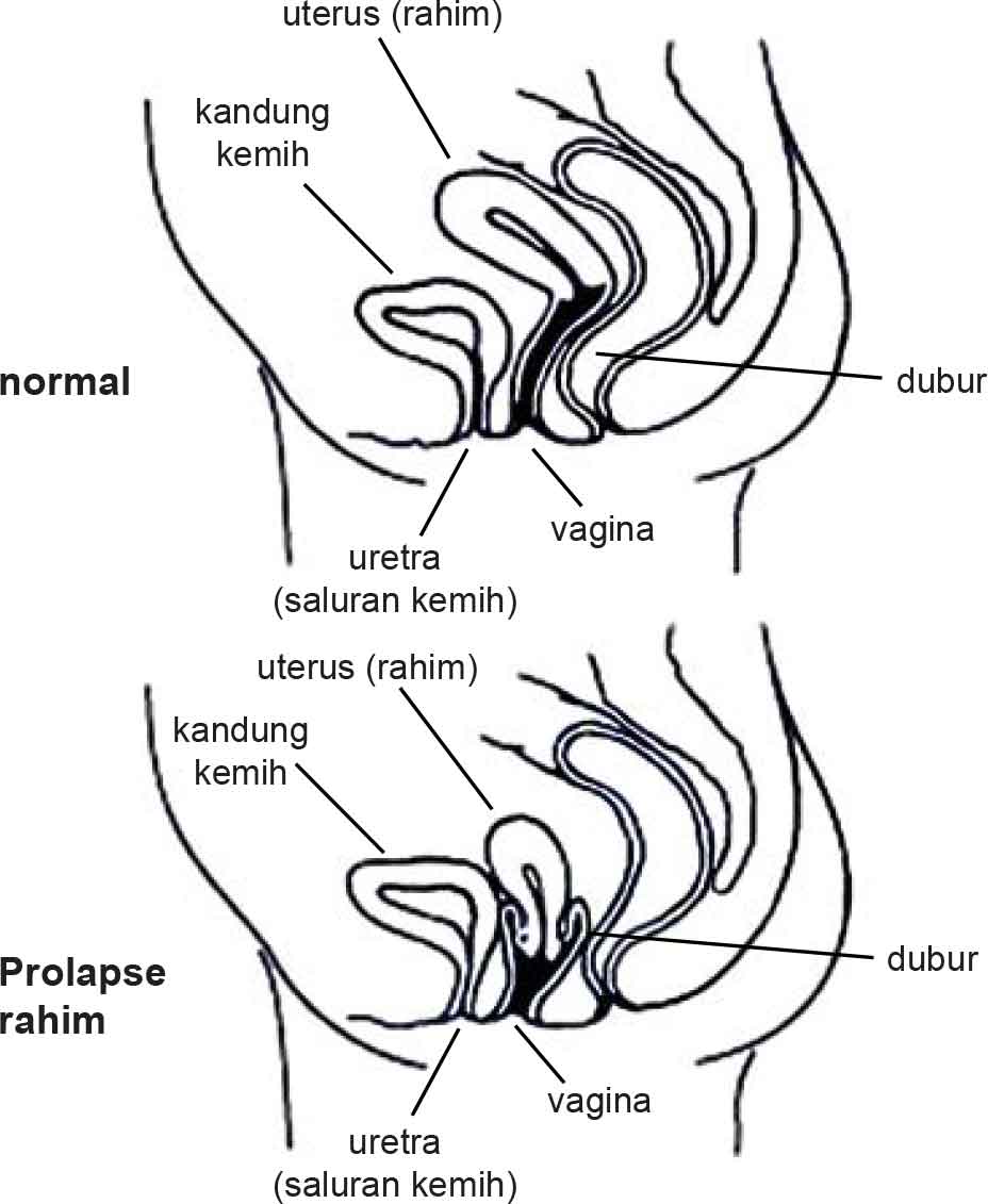 Prolapse