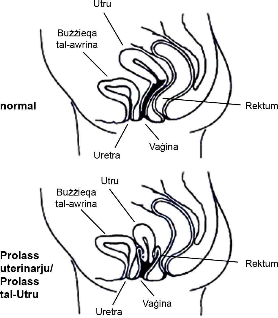 Prolapse