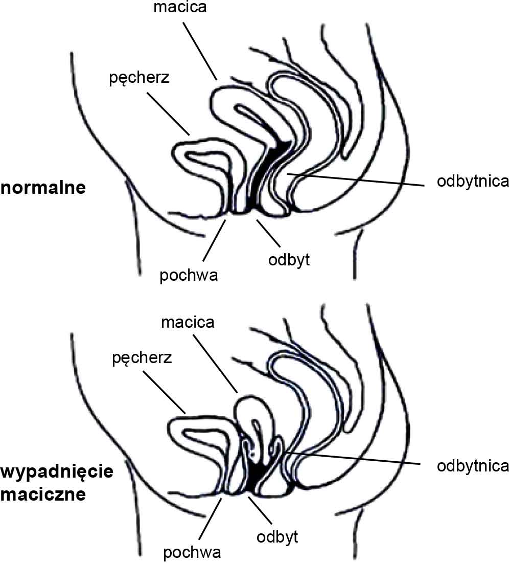 Prolapse