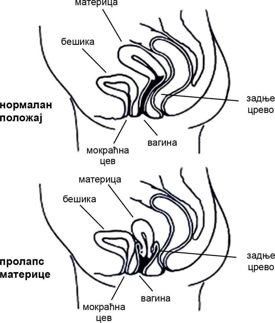 Prolapse