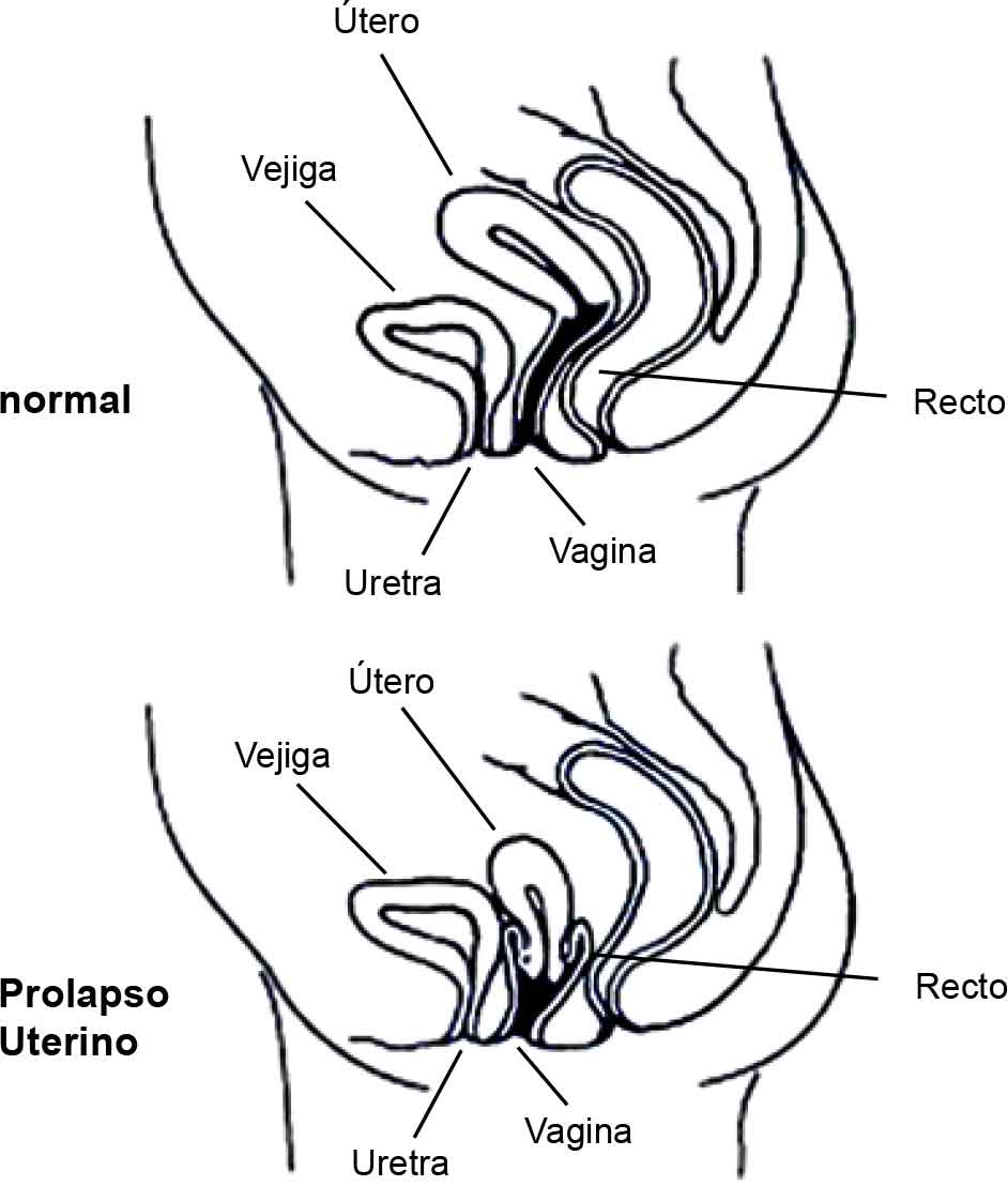 Prolapse