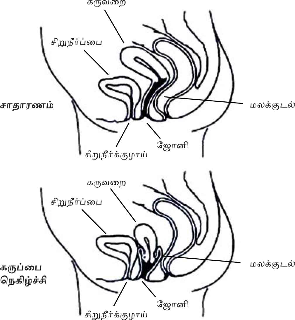 Prolapse