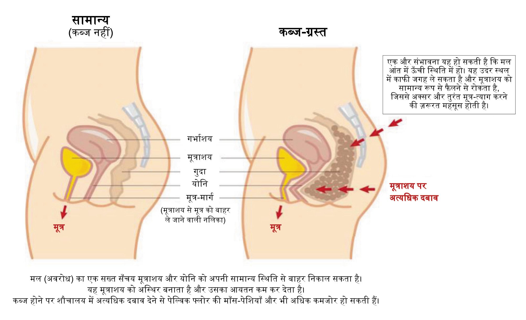 Normal Vs Constipated bowel