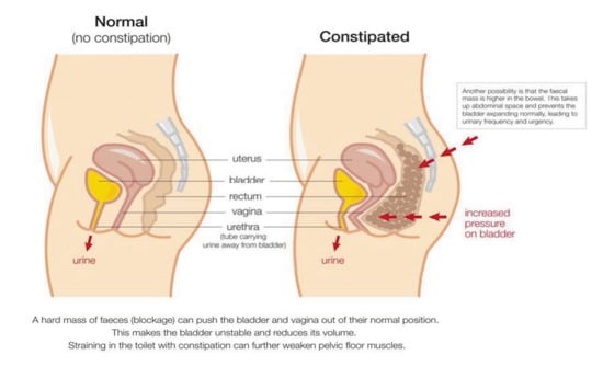 Normal versus Constipation