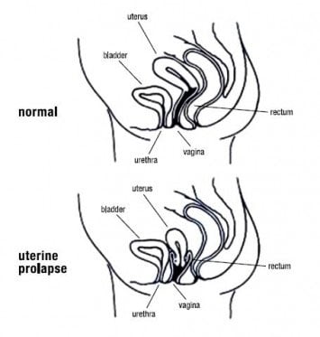 Prolapse diagram