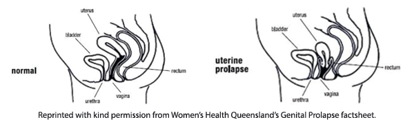 Avoiding Prolapse When You Are Working Out Continence Foundation Of