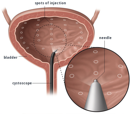 Bladder Botox Diagram