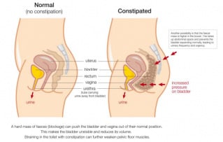 normal vs constipated diagram in english